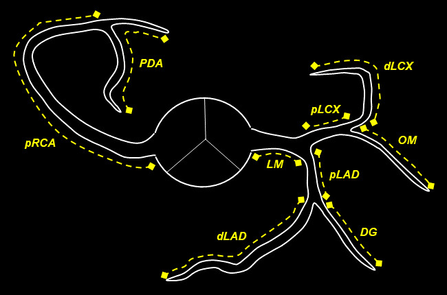 Coronary Anatomy Segments annotated